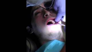 Wisdom Teeth Removal While Awake [upl. by Ibmab]