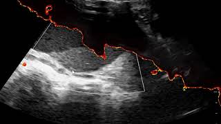 Vernix Casseosa Fetal skin peeling off on ultrasound ScanParadoxies of pregnancy [upl. by Annunciata490]