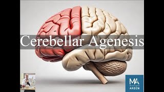 Cerebellar Agenesis [upl. by Hera]