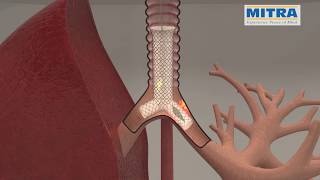 Tracheobronchial quotYquot stent MITRA OTTOMED ENDOSCOPY Interventional Pulmonology [upl. by Falconer]