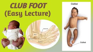 CLUB FOOTTALIPES EQUINOVARUSEpidemiology etiology risk factors classification and Management [upl. by Oaoj]