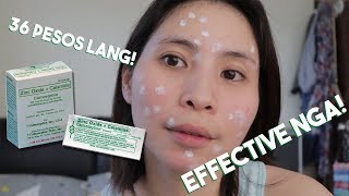 How To Dry Pimples in 3 Days  Affordable Acne Treatment [upl. by Claus]