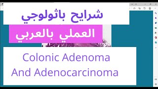 Colon histology  colonic adenocarcinoma  Tubulovillous adenoma low grade and high grade [upl. by Haggai]