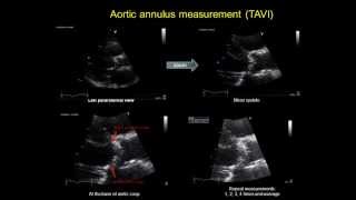 AORTIC ANNULUS MEASUREMENT  TAVI  transcatheter aortic valve implantation [upl. by Ikkaj]