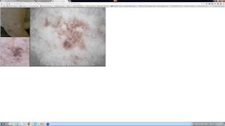 2013 12 08 11 13 Lentiginous melanoma [upl. by Stacia]