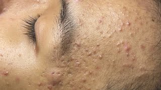 ACNE TREATMENT VU QUYNH MI Acne On Teens Cheek 2024 [upl. by Casavant644]