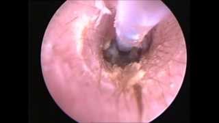 Secretory Otitis media 4 [upl. by Girish]