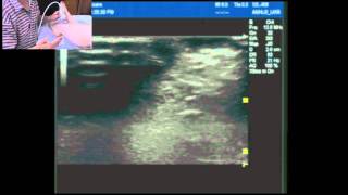 Ultrasound guided ankle block part 2 Supdeep peronealfibular nerves and saphenous nerve [upl. by Merton]