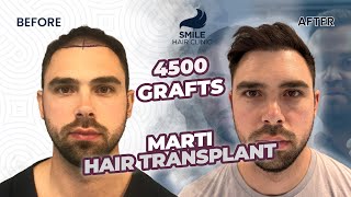 Transformative Hair Transplant Journey  12 Months Before amp After  4500 Grafts [upl. by Maclaine]