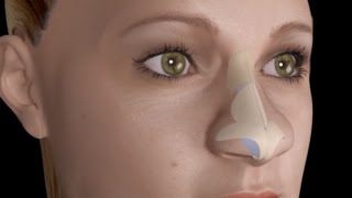 Bulbous Large Nasal Tip Nose Job Rhinoplasty [upl. by Carlile]