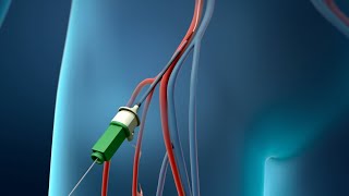 Coronary Angioplasty Femoral Access [upl. by Tisman807]