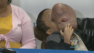 UM Health Doctors To Remove 10 Pound Tumor From Teens Face [upl. by Sudnor]