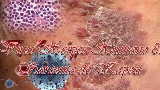 Virus Herpes Humano 8Sarcoma de Kaposi [upl. by Wan]