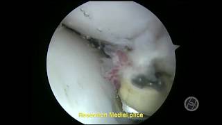 MEDIAL PLICA MY ARTHROSCOPIC TREATMENT Part 1 [upl. by Aeli]