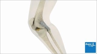 How knee arthroscopy is carried out  Bupa Health [upl. by Web921]