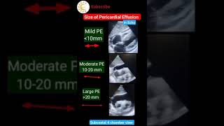 Size of Pericardial effusion in Echo echo ytshortsvideo shortsvideo [upl. by Annayoj]