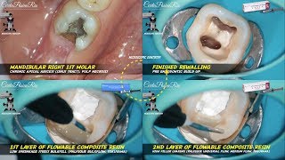 rewalling pre endodontic build up palfique bulk flow tokuyama essence matrix mandibular molar [upl. by Ativoj]