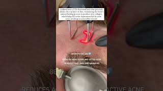 Acne Scars Skin Tightening Botox and Lip Fillers by Skinsation LA [upl. by Alyac992]