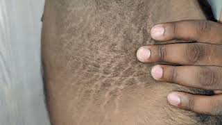 Acanthosis Nigricans [upl. by Einhapets732]