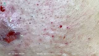 Big Cystic Acne Blackheads Extraction Blackheads amp Milia Whiteheads Removal Pimple Popping [upl. by Rabjohn]