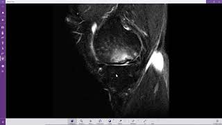 Fratura de insuficiência no côndilo femoral medial [upl. by Gunnar]