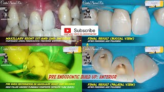 rewalling pre endodontic build up estelite flow quick anterior teeth incisive pop dentistry tokuyama [upl. by Howey205]