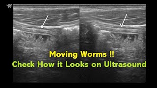 Intestinal Helminthiasis Ascariasis  Ultrasound  Case 04 [upl. by Cresa430]