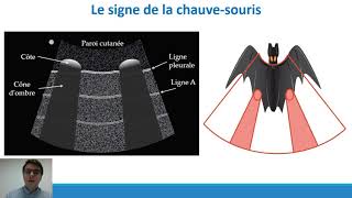 Elearning n°1  Echographie pleuropulmonaire dans la dyspnée aiguë  Thèse François M [upl. by Kraft]