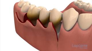 Periodontal flap approach surgery  Lapointe dental centres [upl. by Ecidnacal]