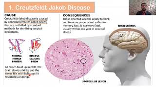 Types of Prions Diseases  Prions diseases in Animals and Human  Part 02 [upl. by Dotson708]