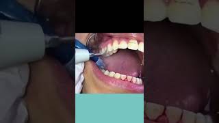 Braces Removal Procedure [upl. by Ahras161]