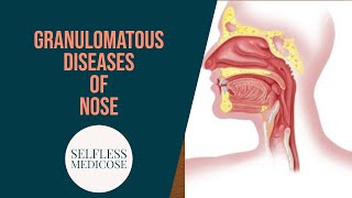 GRANULOMATOUS DISEASES OF NOSE part 3 mucormycosis wegeners granulomatosis in detail [upl. by Assiram459]