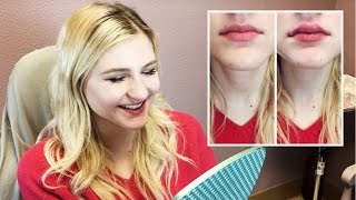 1 Syringe of Juvederm Lip Injections from Doctor Cynthia Cote [upl. by Nylirej154]