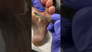 Watch as an expert Aussie podiatrist tackles forefoot callus removal Podiatry [upl. by Siuqramed735]