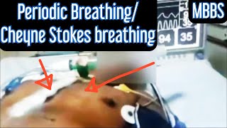 Periodic Breathing Cheyne Stokes Breathing mbbs medicine neetpg usmle next aiims neet [upl. by Durwin]