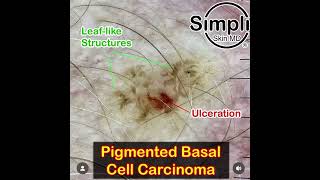 Pigmented Basal Cell Carcinoma Dermoscopy [upl. by Nuarb]