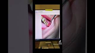 Root canal therapy of tooth 14 [upl. by Thury]