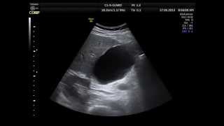 BILE DUCT FISTULA  ULTRASOUND [upl. by Anatola18]