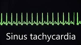 Sinus rhythm bradycardia and tachycardia [upl. by Ayle]