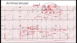 Arritmia Sinusal EKG [upl. by Bandeen948]