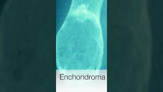 Enchondroma  Pathology shorts [upl. by Lebazi]