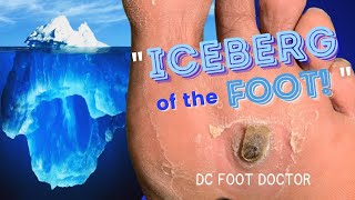 Iceberg of the Foot Removing Painful Pororkeratosis [upl. by Bernardine596]