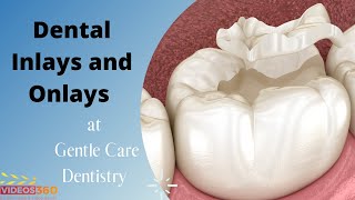 Dental Inlays and Onlays explained by Dr Brianne Luu [upl. by Cookie]