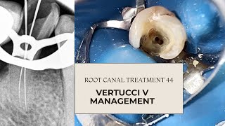 Management of Vertucci V Lower Premolar root canal treatment [upl. by Blynn]