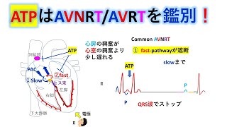 心電図：暗記からの卒業 132話 ATPによる上室性頻拍の鑑別２ [upl. by Chappelka]