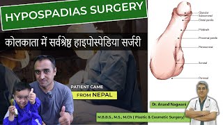 Best HYPOSPADIAS Surgery in Kolkata  Patient Came from Nepal  Best Age for Hypospadias Surgery [upl. by Rodgiva]