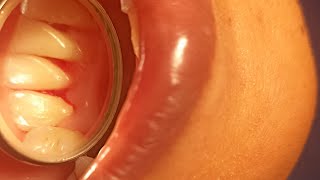 clear your doubts about a scaling procedure at a dentist all answered do watch till the end [upl. by Denver901]