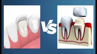 Veneers vs Crowns  Whats the Difference [upl. by Leruj]