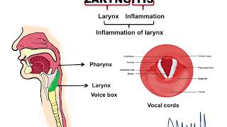 Laryngitis [upl. by Wilmer]