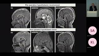 Pediatric Craniopharyngioma Pt1 Craniopharyngioma  Overview and Classification [upl. by Liryc]